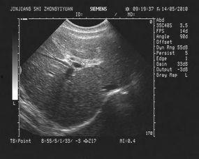 肝及虫视频,揭秘肝脏健康与寄生虫防治之道