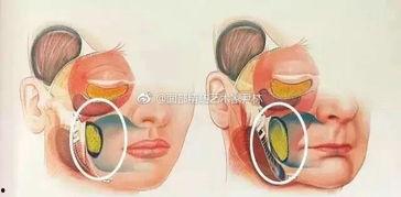 颊脂垫视频,面部轮廓塑造的秘密武器