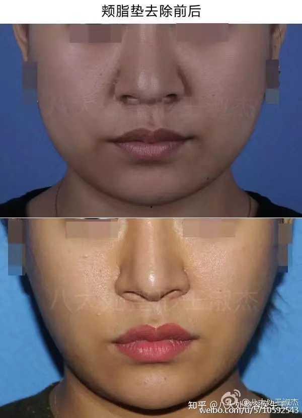 颊脂垫视频,面部轮廓塑造的秘密武器