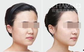 颊脂垫视频,面部轮廓塑造的秘密武器